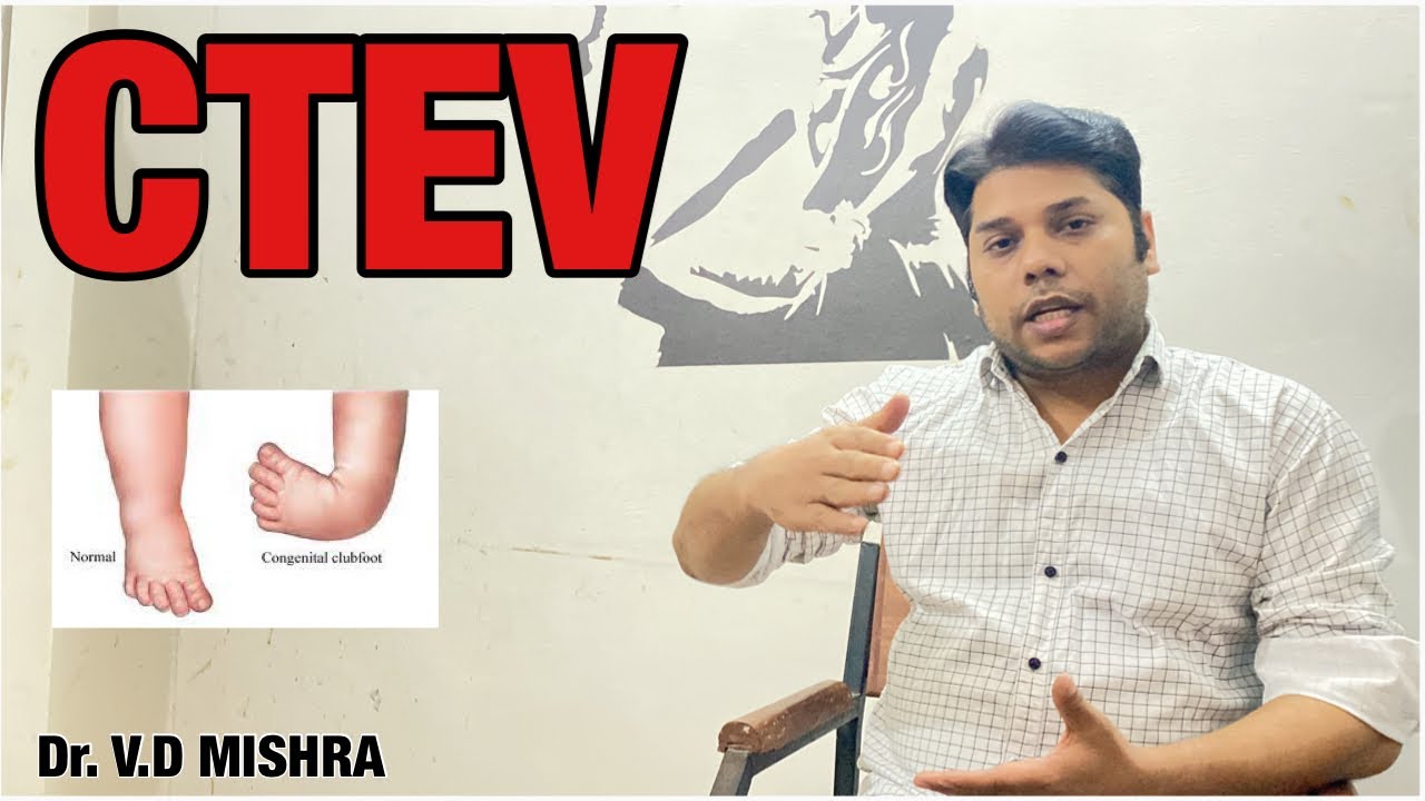 CTEV by DR. V.D MISHRA (orthopaedic Surgeon)