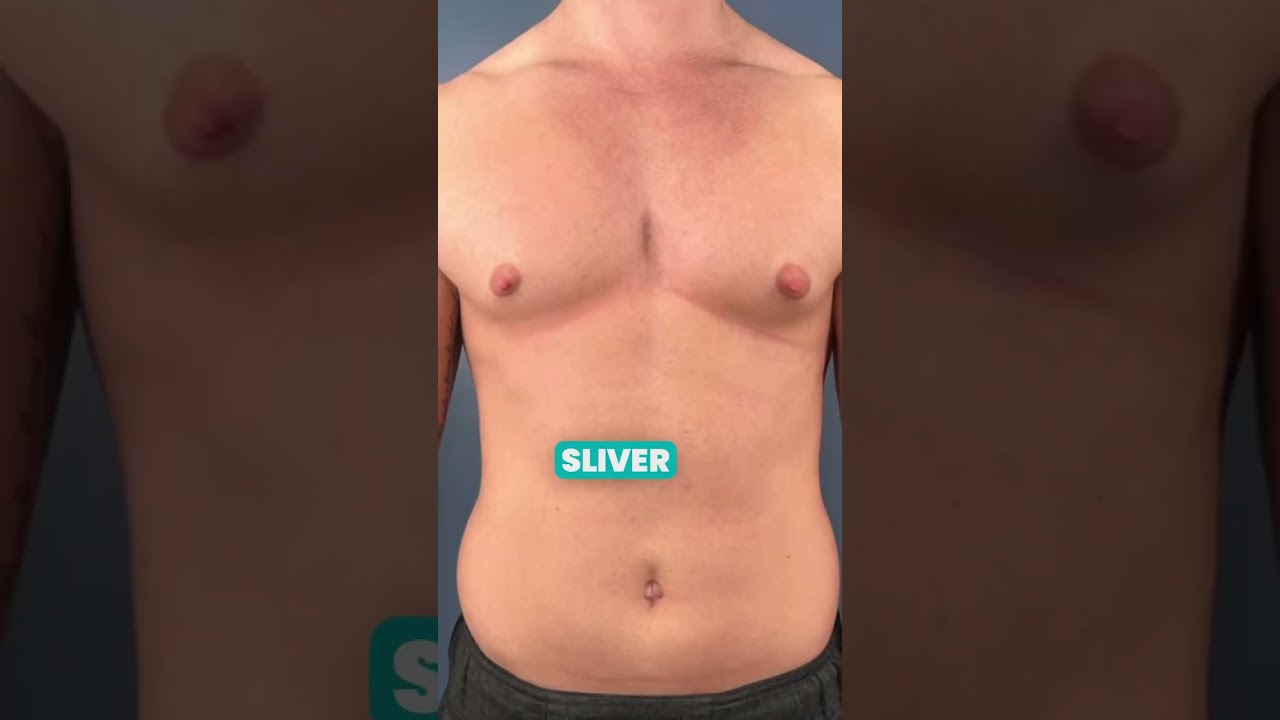 This Is What Type-2 Gynecomastia Actually Looks Like