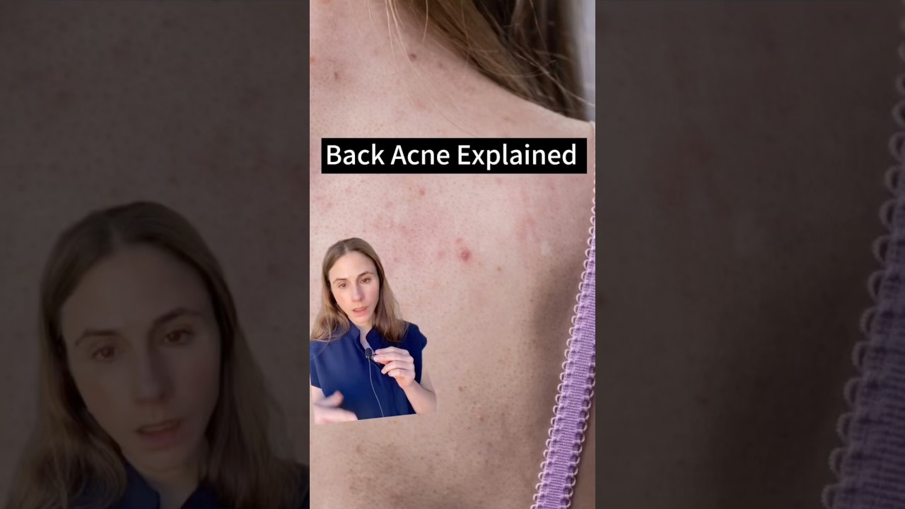 Uncovering The Truth About Back Acne
