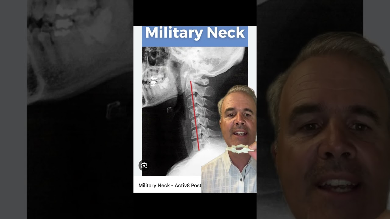 Military neck can be caused by neck misalignment | brain fog, neck pain, vertigo treatment Sarasota