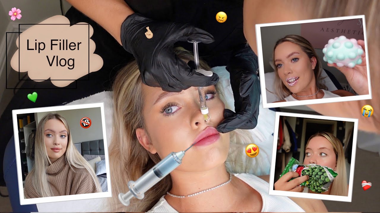 MY FIRST TIME GETTING LIP FILLER!! *APPOINTMENT, PROGRESS + Q&A* | full experience&hellip; VLOG🤞🏼 xx