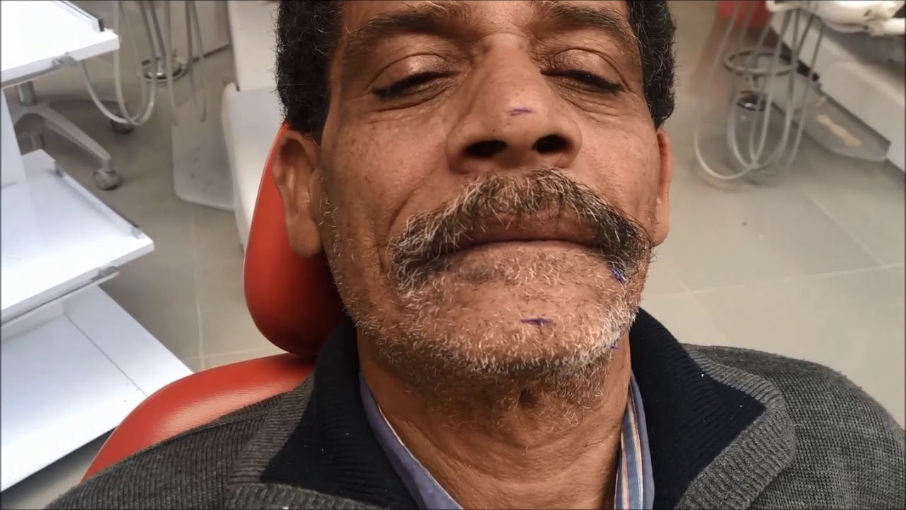 Part II of bite Registration for completely edentulous patient ( vertical , centric relations adjust