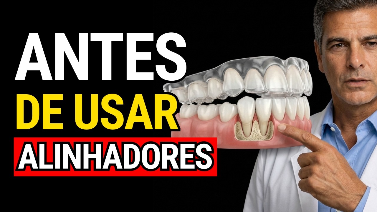 Alinhadores Com Coroas Implantes Ou Gengiva Fraca Como Evitar Problemas