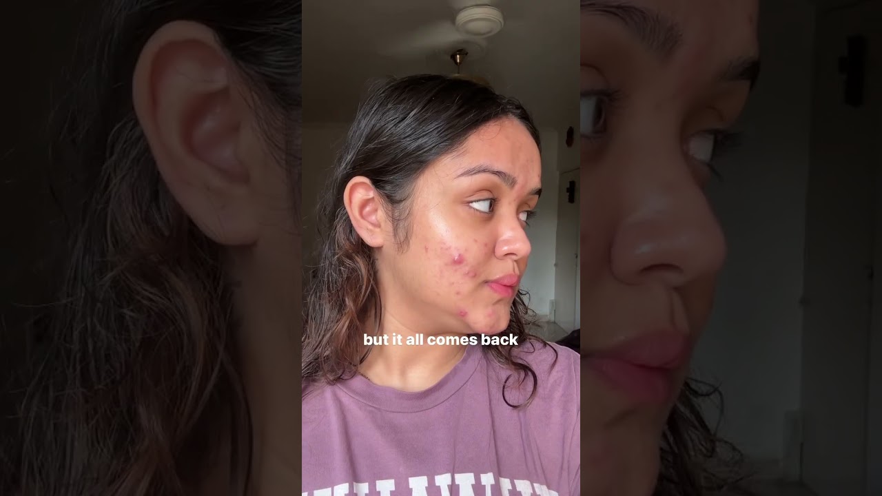 acne positivity🤍 #acnepositivity #acneproneskin #acne