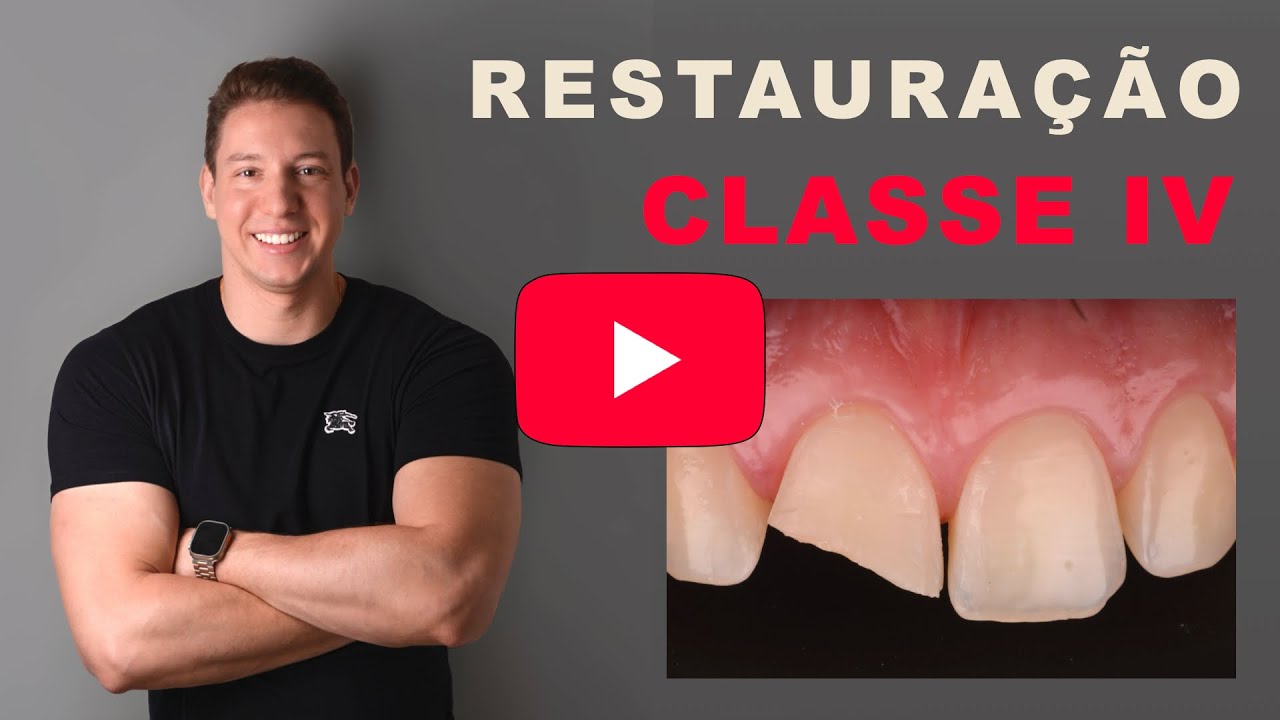 Restauração Classe IV - Técnica da Guia de Silicone