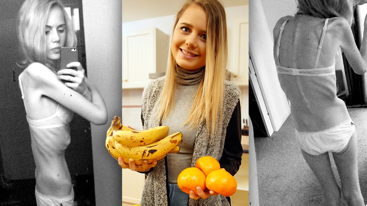 Hours From Death: Anorexia Sufferer&rsquo;s Incredible Recovery