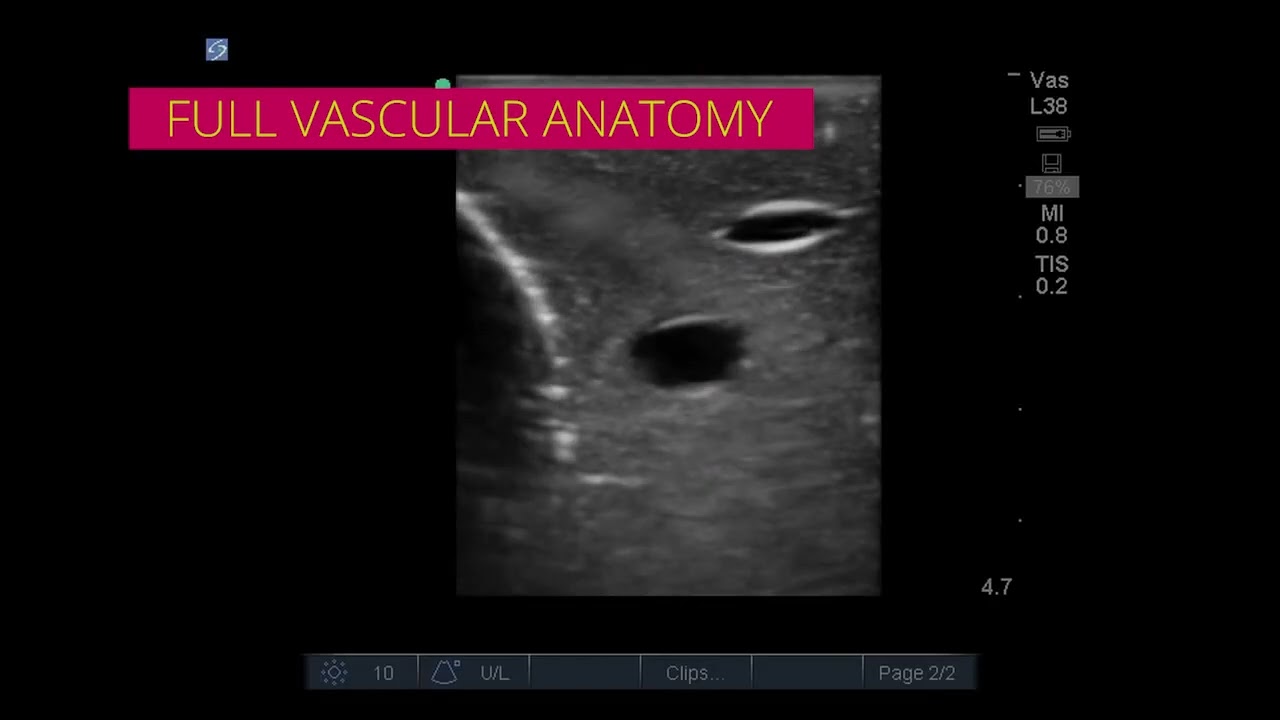 WorldPoint | CAE Blue Phantom™ Gen II Ultrasound Central Line Training Model
