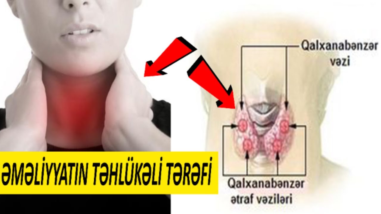 Zob əməliyyatının fəsadları - BU CÜR müalicə edilir
