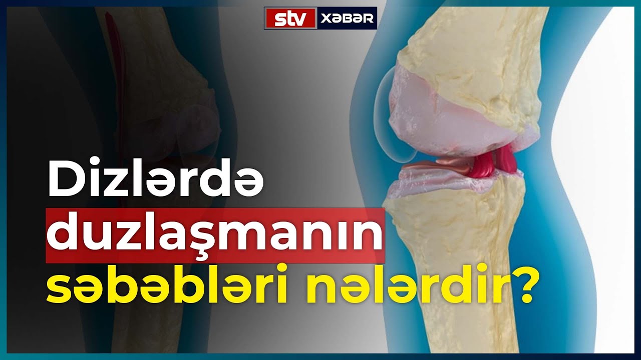 Dizlərdə duzlaşmanın səbəbləri nələrdir? - STV XƏBƏR