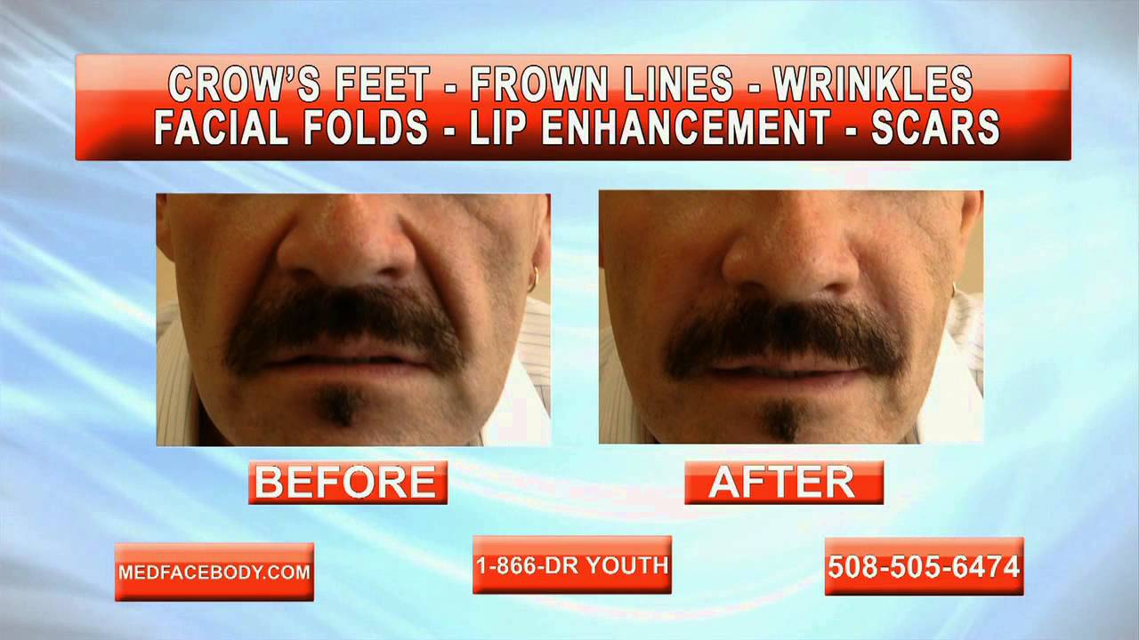Botox & Facial Fillers Web Video by Dr. Dave David