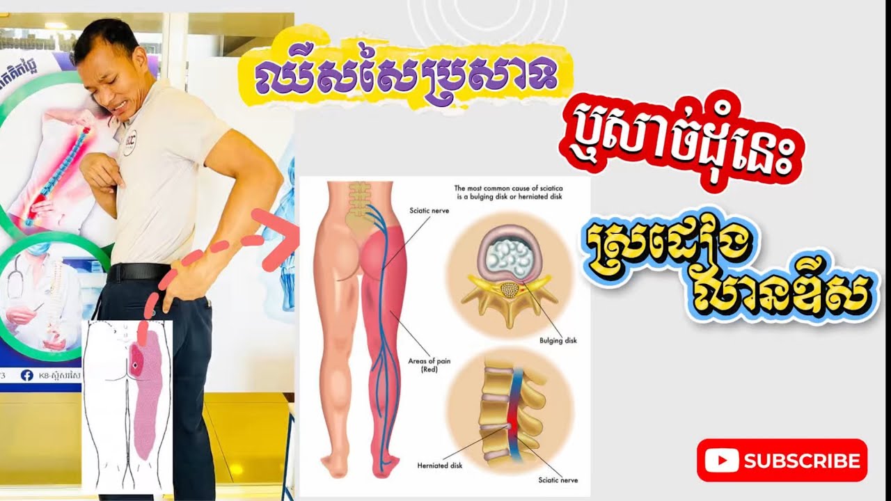 ឈឺសាច់ដុំមួយនេះគឺស្រដៀងនិងការលានឌីសដែរ ឬ គៀបសសៃ