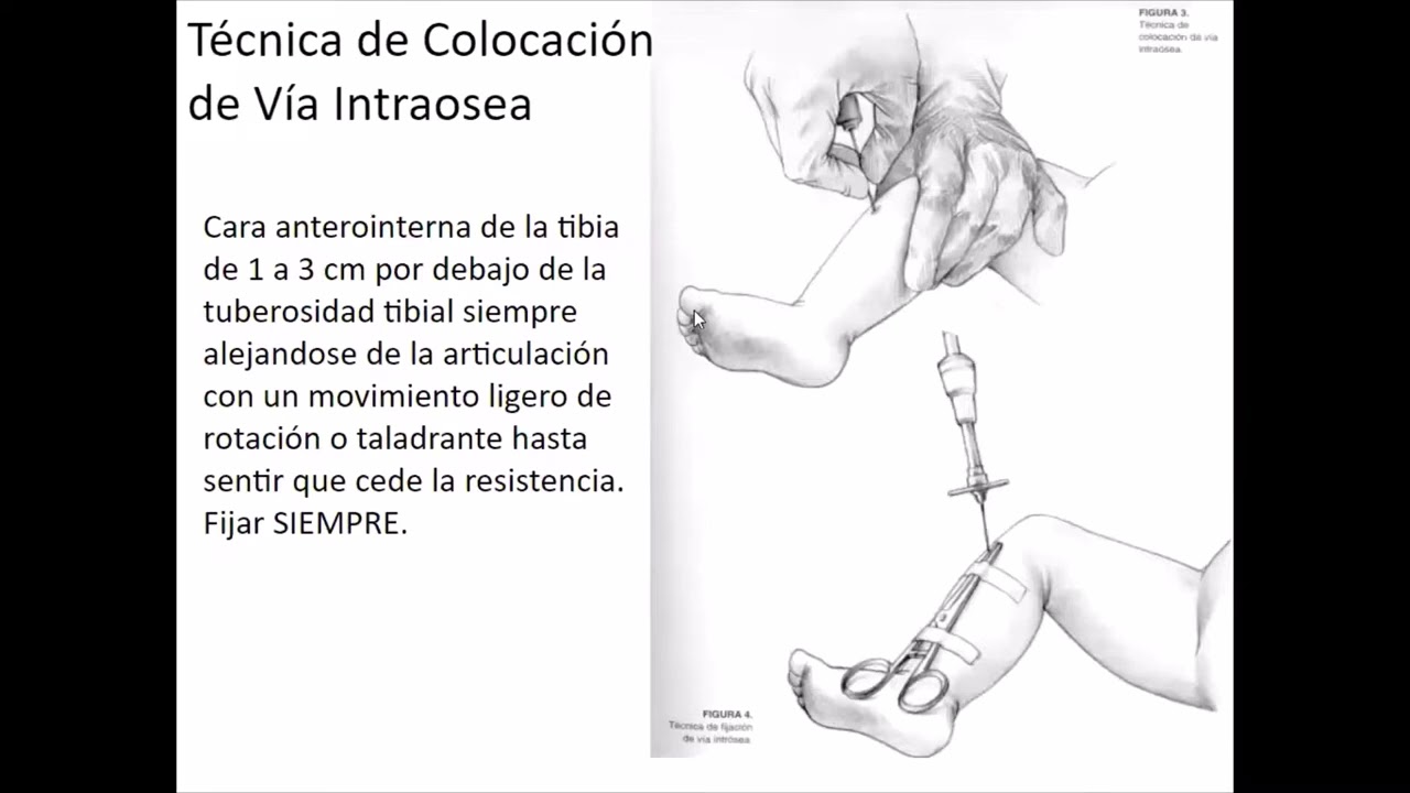 Vía intraosea en pediatría  Curso Superior de Emergencias  2023