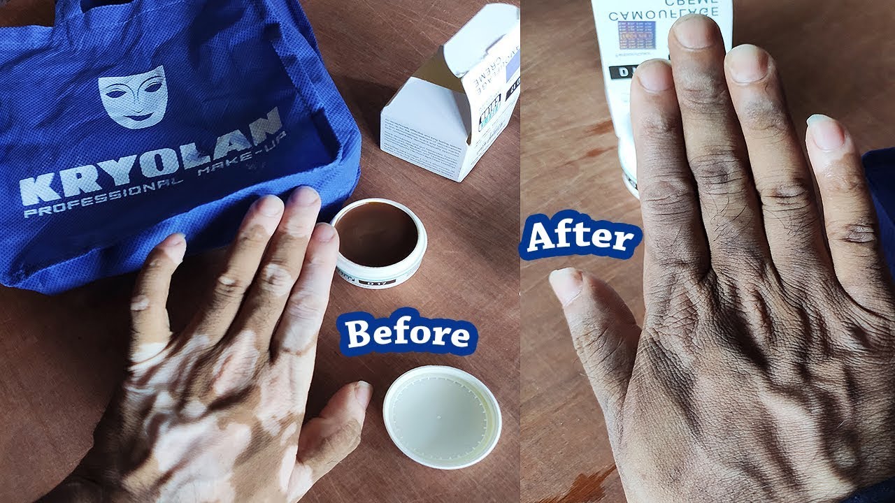 Best Makeup for Vitiligo | Waterproof Camouflage Cream