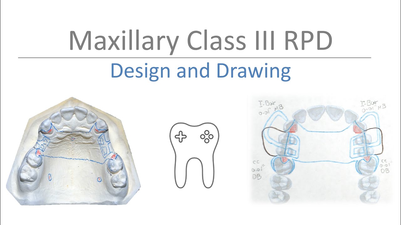 Maxillary Class III RPD Design: Step-by-Step Guide to Surveying & Drawing on Casts and Paper