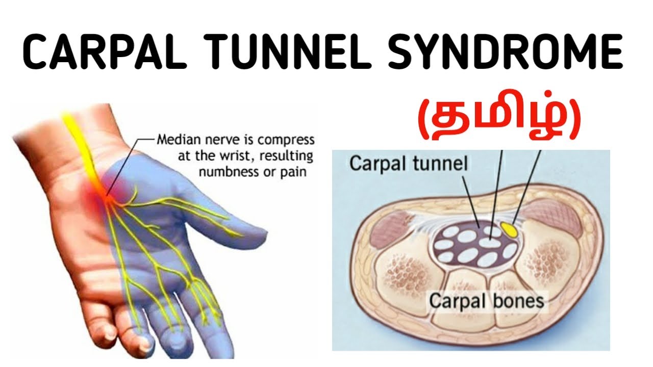 Carpal Tunnel Syndrome | Causes | Symptoms | Investigation | Treatment | தமிழ்