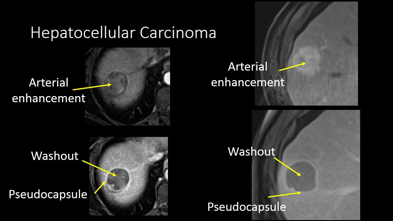 GI Imaging - Cirrhosis