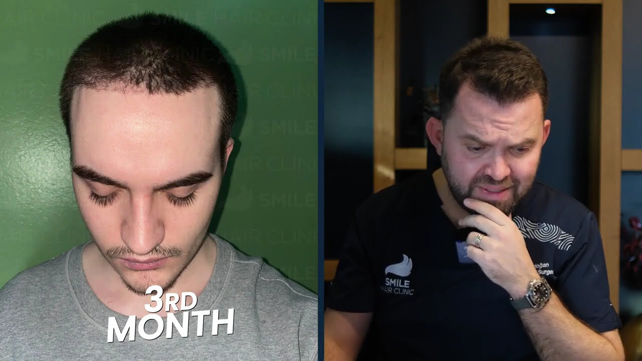 Case Study: 2150 Grafts | 12-Month Result | Dr. Mehmet Erdoğan, Smile Hair Clinic