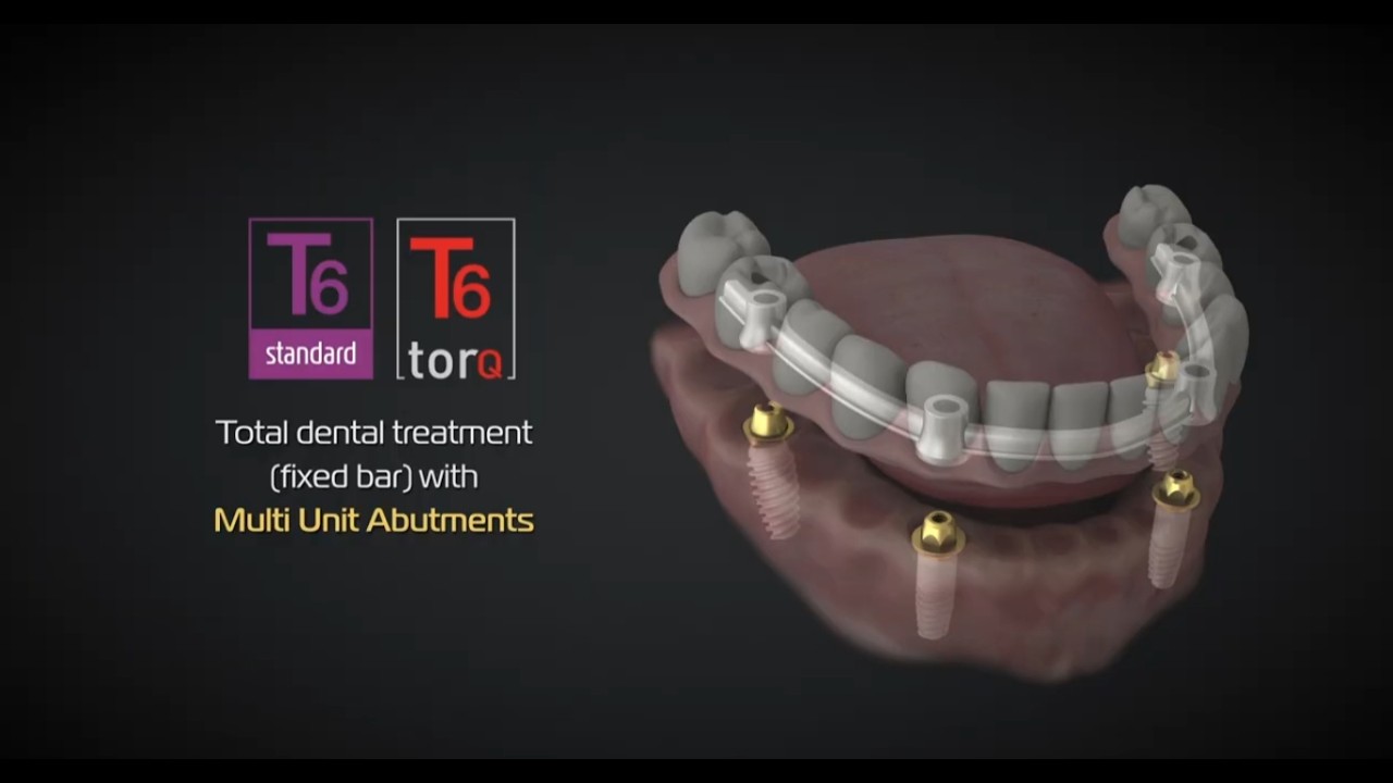 NucleOSS Multi Unit Abutments | Total Dental Treatment | Fixed Bar