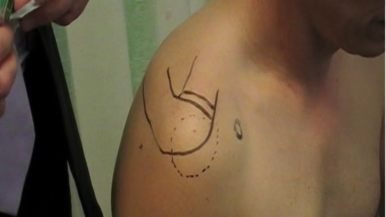 Shoulder Injections in General and Physiotherapy Practice