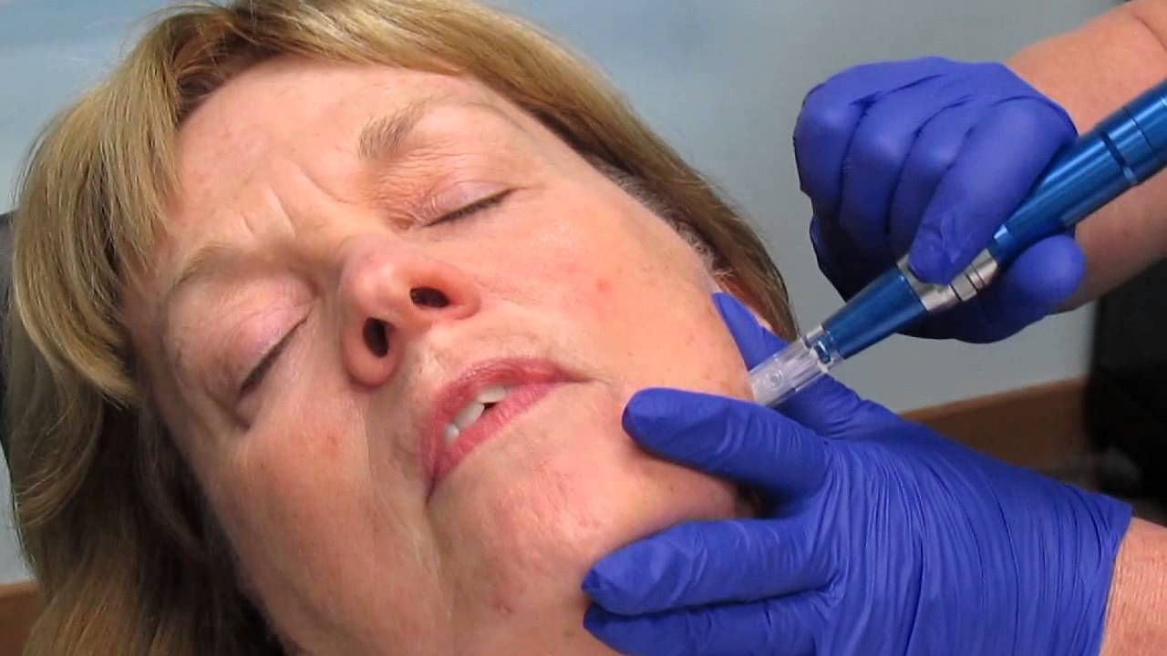 Skin Pen (Microneedling)