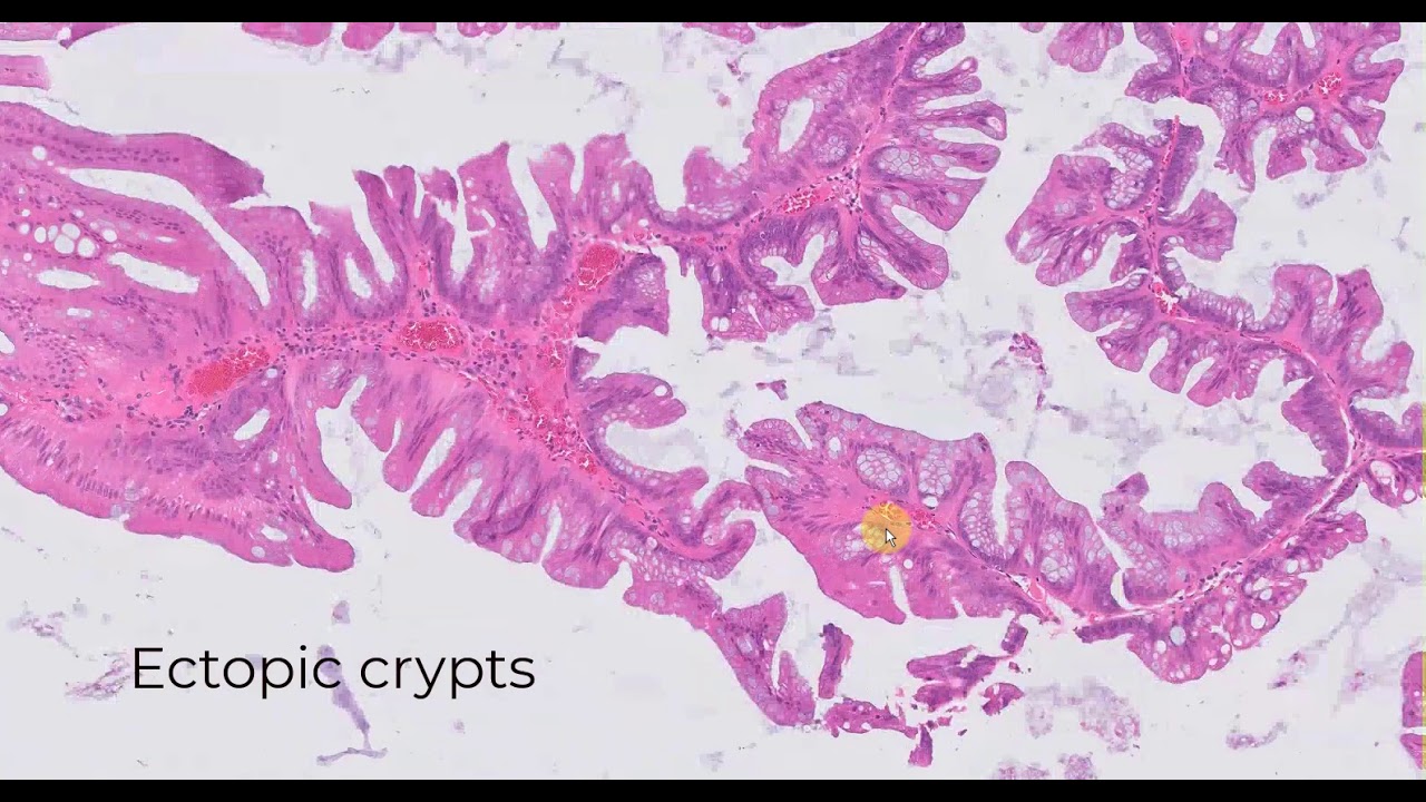 Traditional serrated adenoma