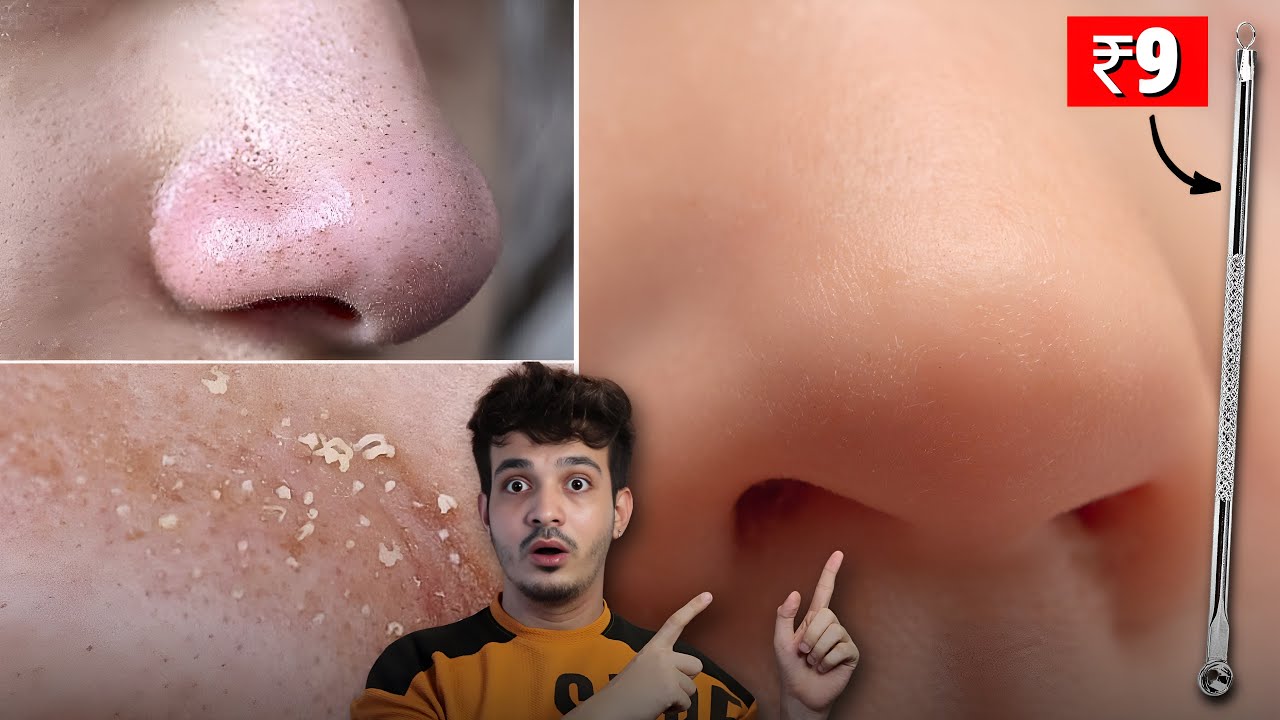 OMG! This Tool Remove Blackheads & Whiteheads Like Magic! 😱