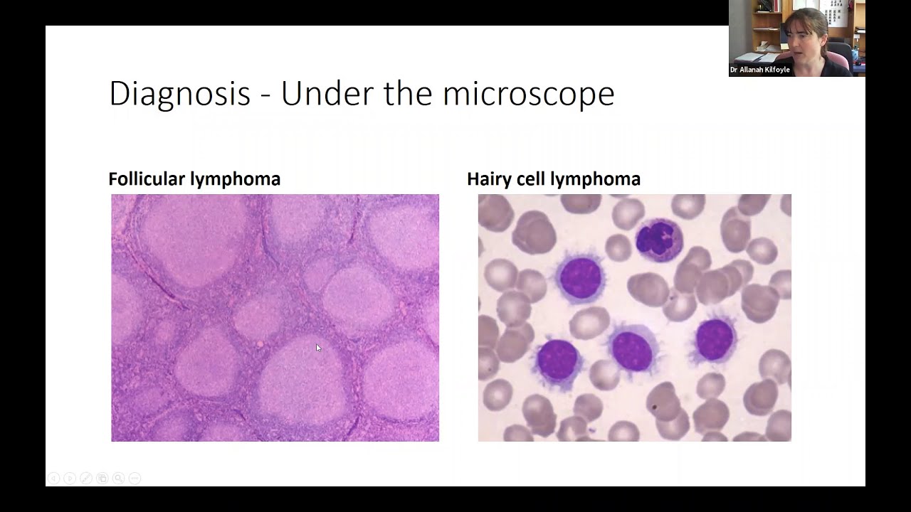 Indolent B cell Lymphomas presented by Dr Allanah Kilfoyle