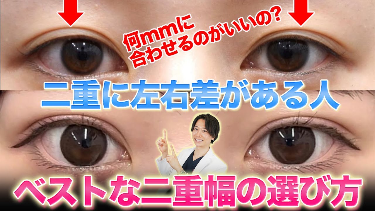 【二重整形】目の開きに左右差がある場合のベストな二重幅の選び方【二重埋没】