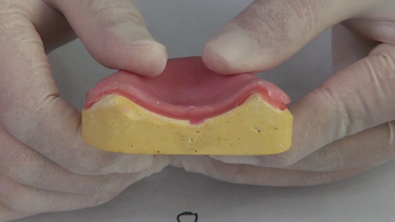 Denture Relining (Rebase)
