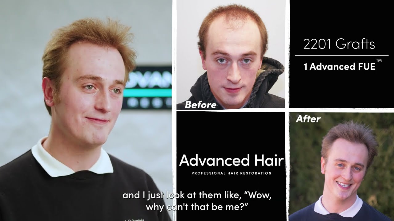 Maxim's Amazing Advanced FUE Transformation | Advanced Hair Experience