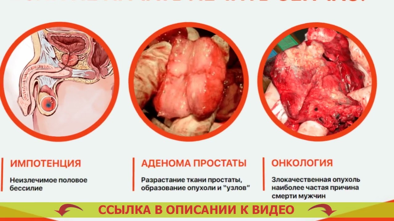 💡 КИТАЙСКАЯ МЕДИЦИНА ЛЕЧЕНИЕ ПРОСТАТИТА 💯 САМЫЕ ЭФФЕКТИВНЫЕ МЕТОДЫ ЛЕЧЕНИЯ ХРОНИЧЕСКОГО ПРОСТАТИТ