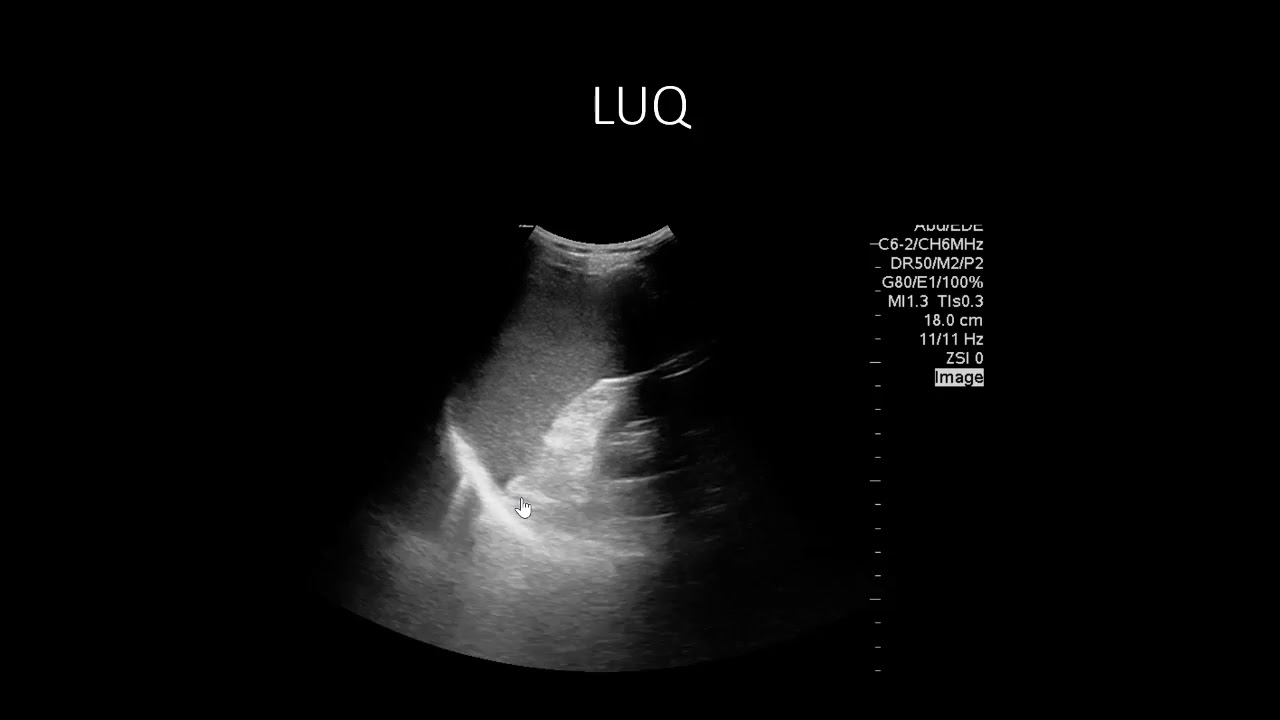 POCUS Cases 9: Abdominal Free Fluid