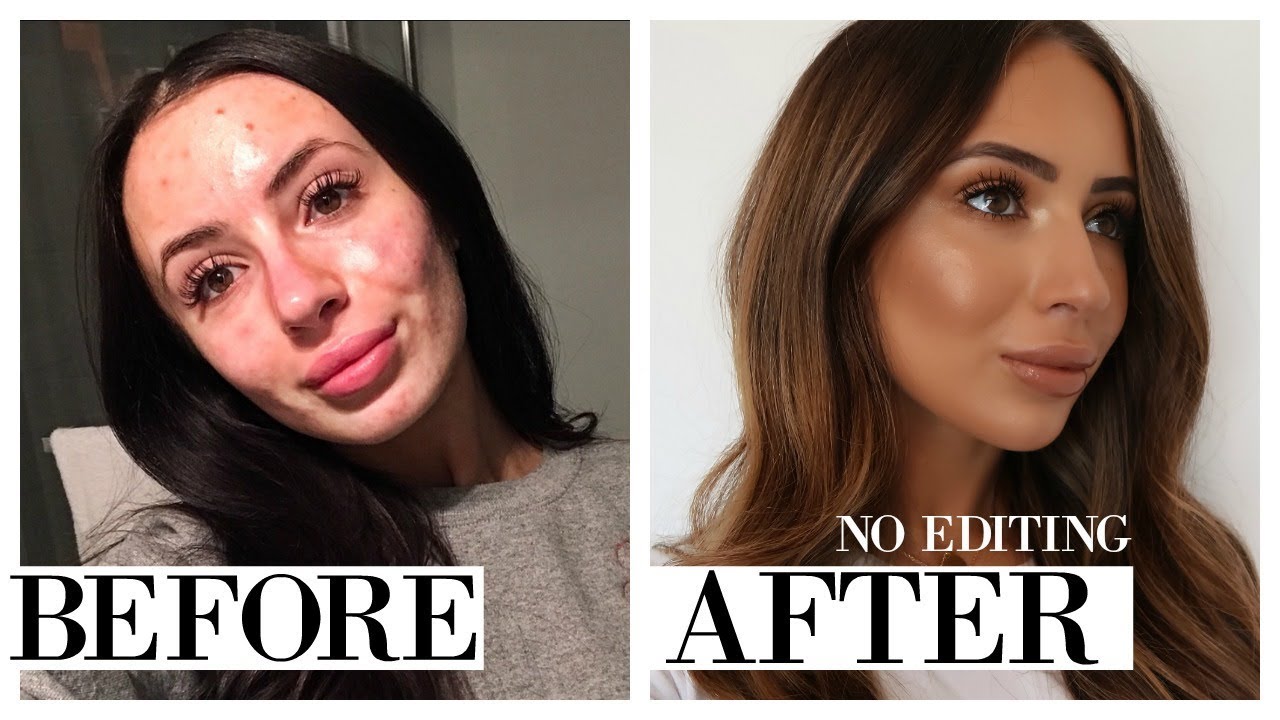 THE ONLY PRODUCTS THAT HAVE EVER CLEARED MY ACNE