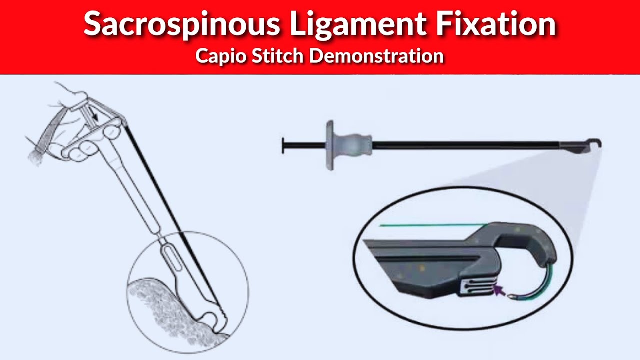 Sacrospinous Ligament Fixation - Capio Stitch Demonstration | Dr Kunal Rathod