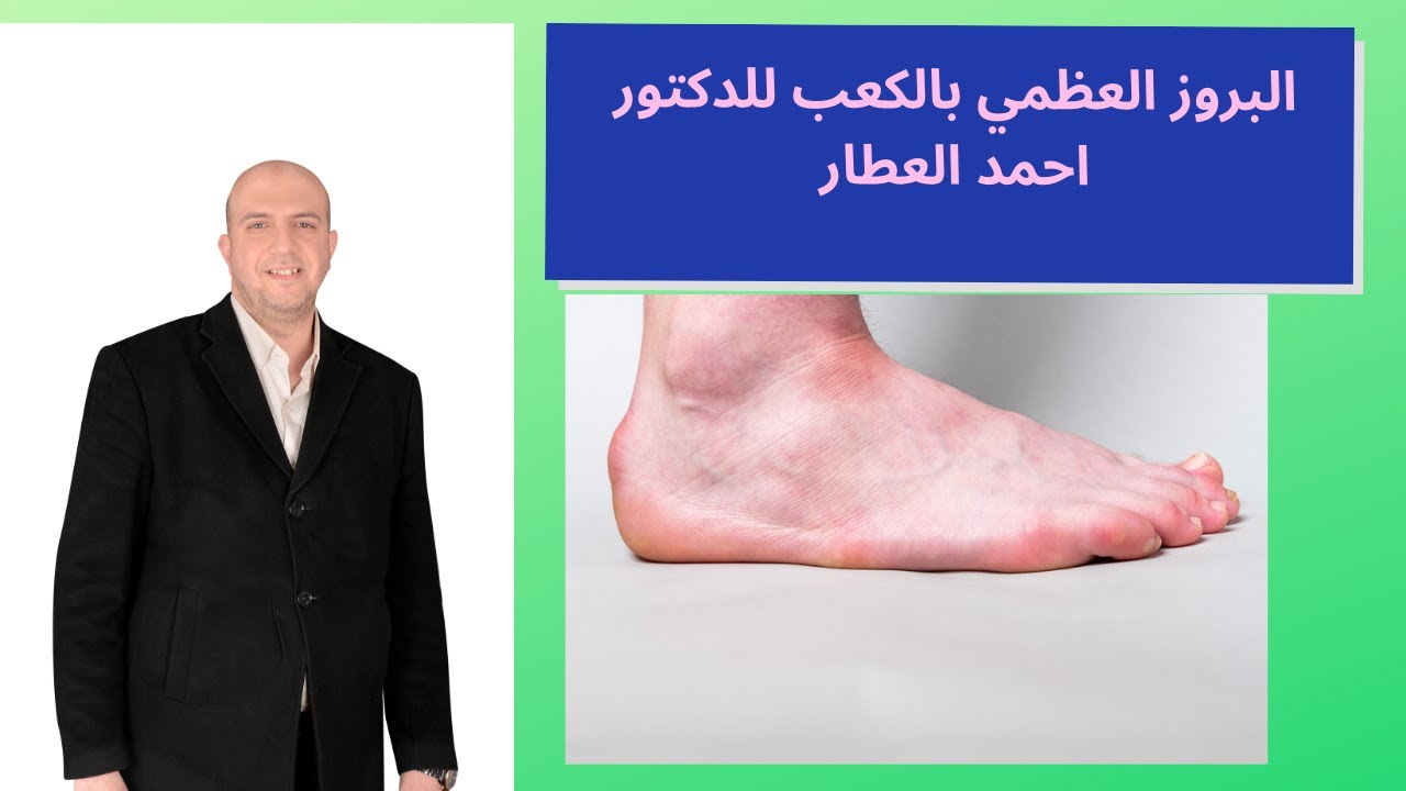 البروز العظمي الخلفي للكعب للدكتور احمد العطار