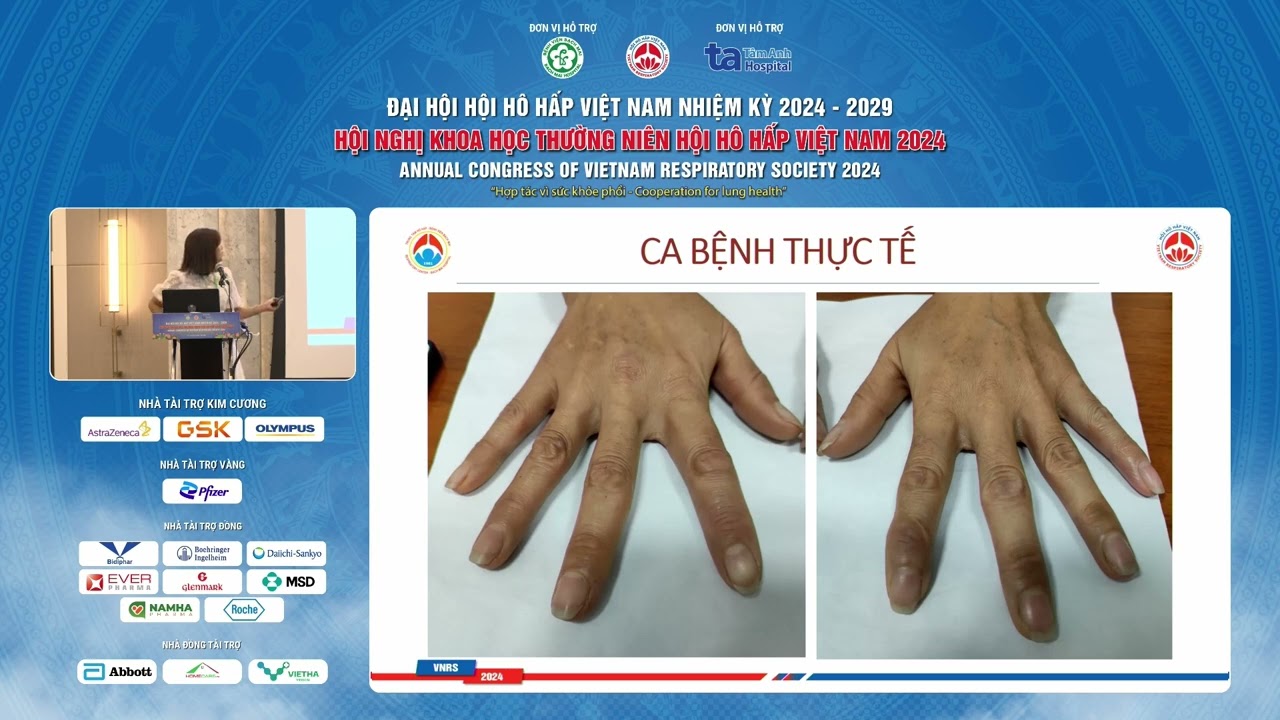 Tiếp cận thực hành lâm sàng người bệnh phổi kẽ mới phát hiện