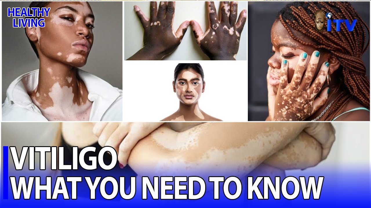 Understanding Vitiligo | HEALTHY LIVING