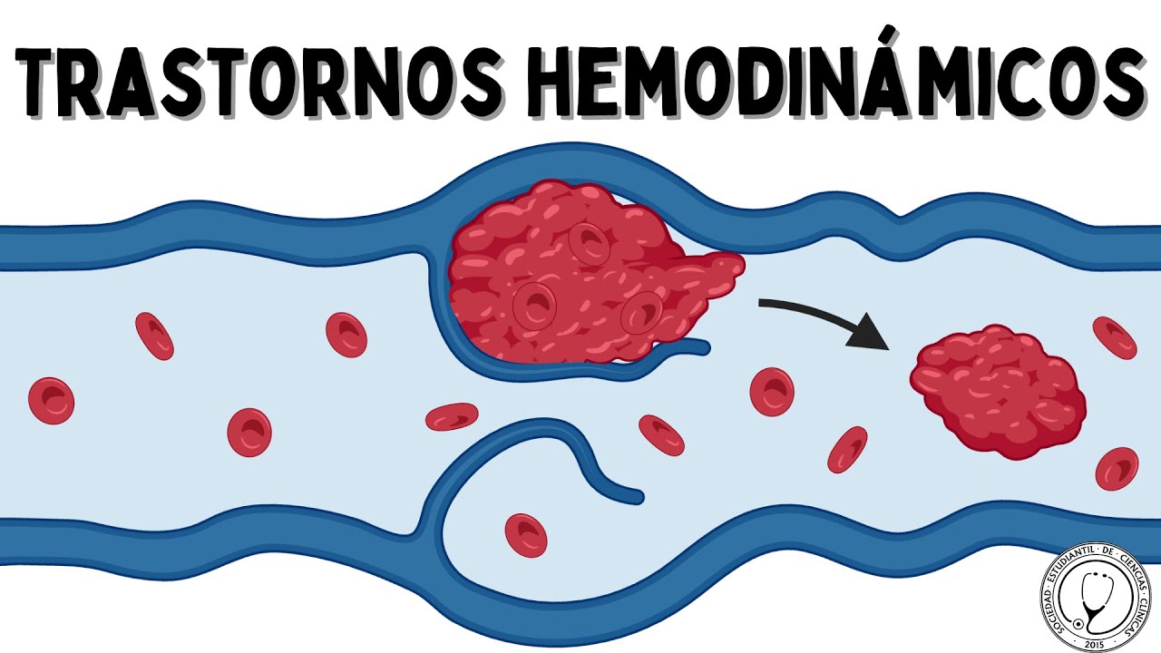 TRASTORNOS HEMODINÁMICOS: Hiperemia, Congestión, Edema, Efusión, Hemostasia, Trombosis y Embolismo