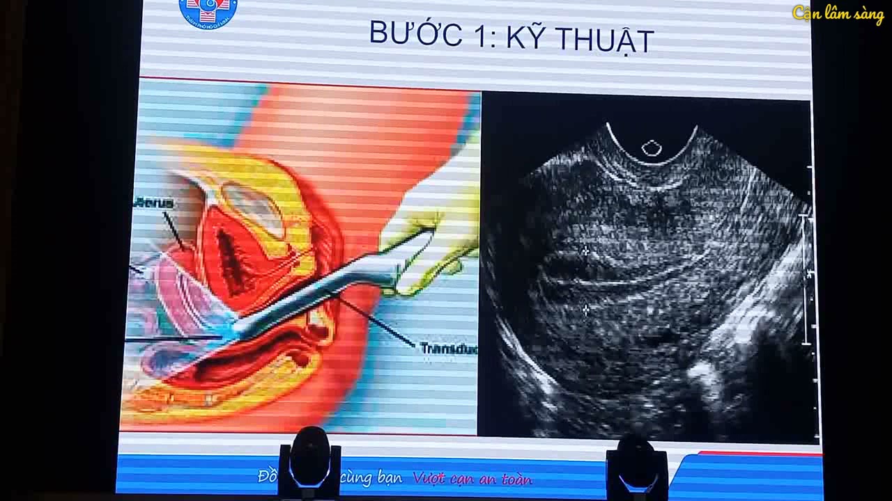 SIÊU ÂM KHẢO SÁT CHẬU NỮ | BS. PHẠM VÕ THÙY LINH