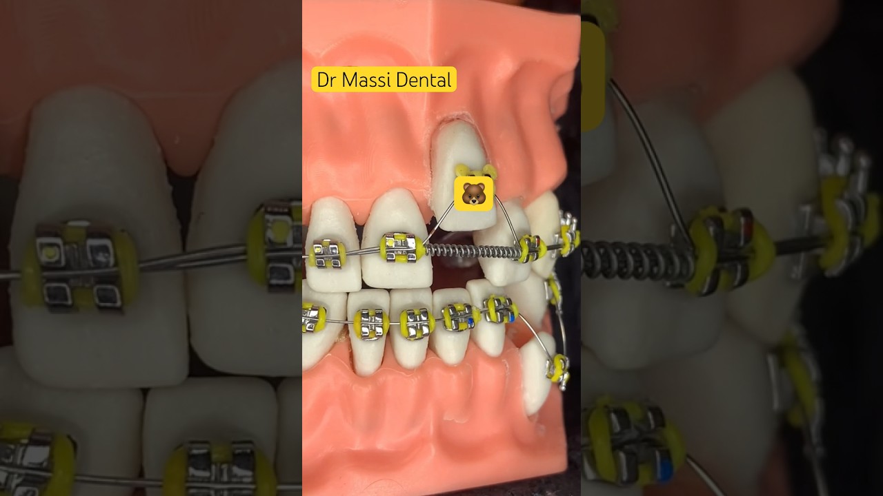 Yellow Colour Braces , Tooth Vlog Orthotics