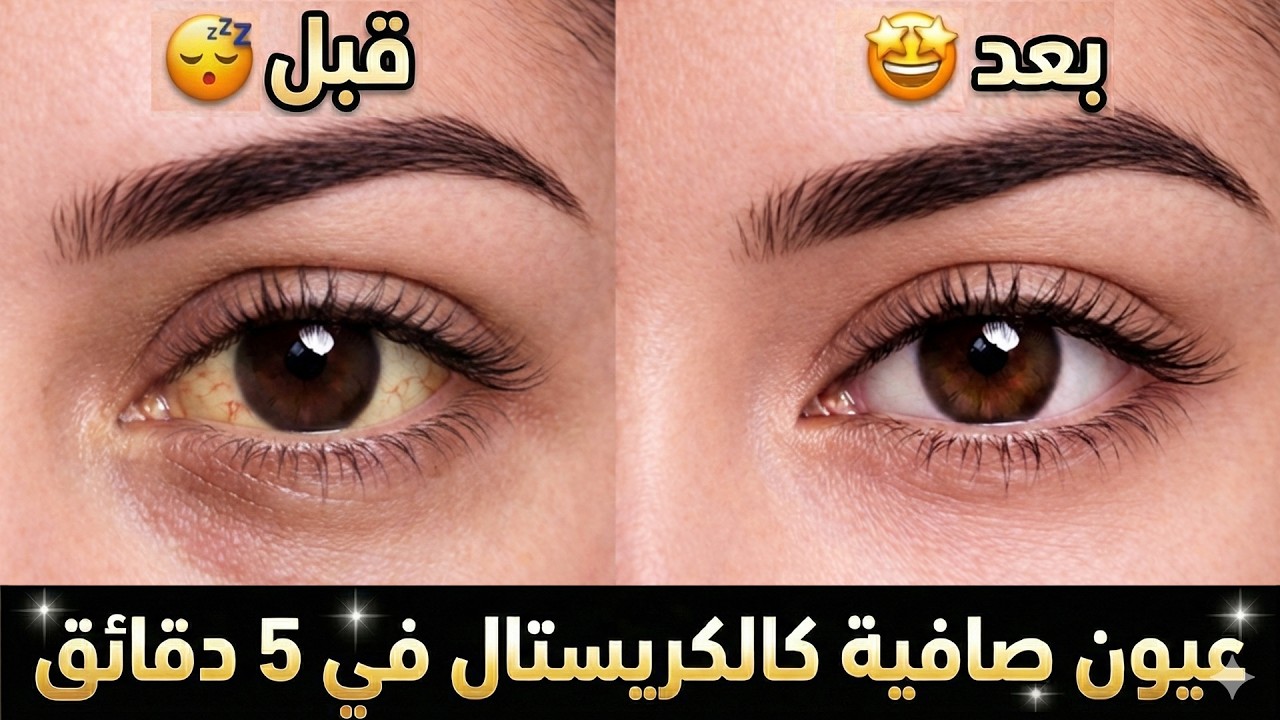 احصلي على عيون لامعة كالماس في 5 دقائق 💎 تبييض بياض العين وإزالة الاحمرار (بدون قطرة)