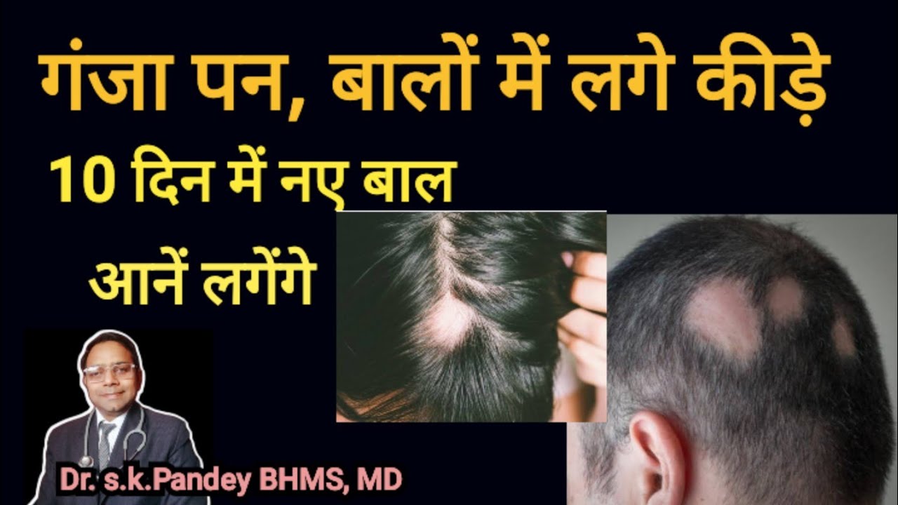 बालों में कीड़े लगने, गंजापन की सबसे अच्छी दवा। Alopacia areata। Dr.s.k.Pandey BHMS, MD