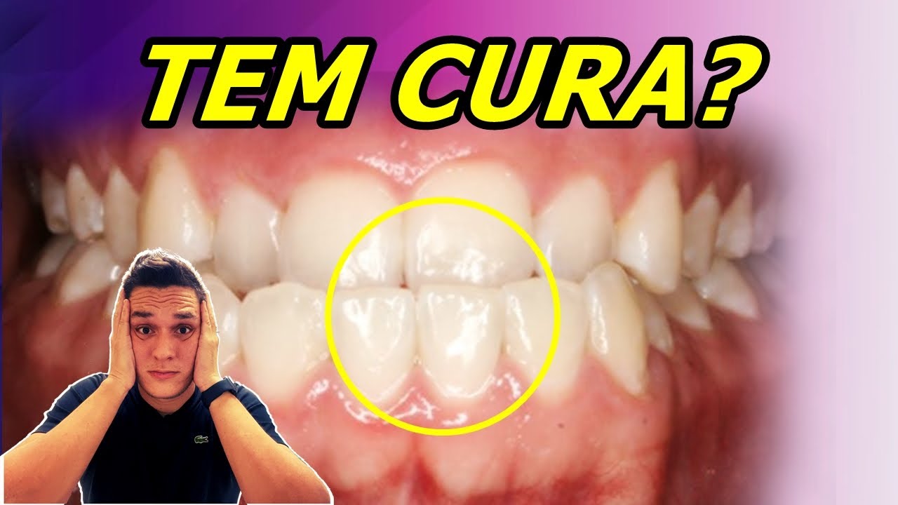 MORDIDA CRUZADA | CAUSAS E TRATAMENTO COM APARELHO!!!