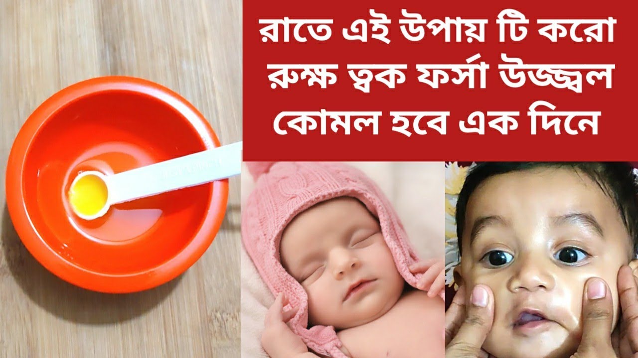শীতে বাচ্চাদের ত্বক কোমল নরম ও উজ্জ্বল করবে এই উপায়ে। রুক্ষতা ও শুষ্কতা দূর করবে।Winter SkinCare