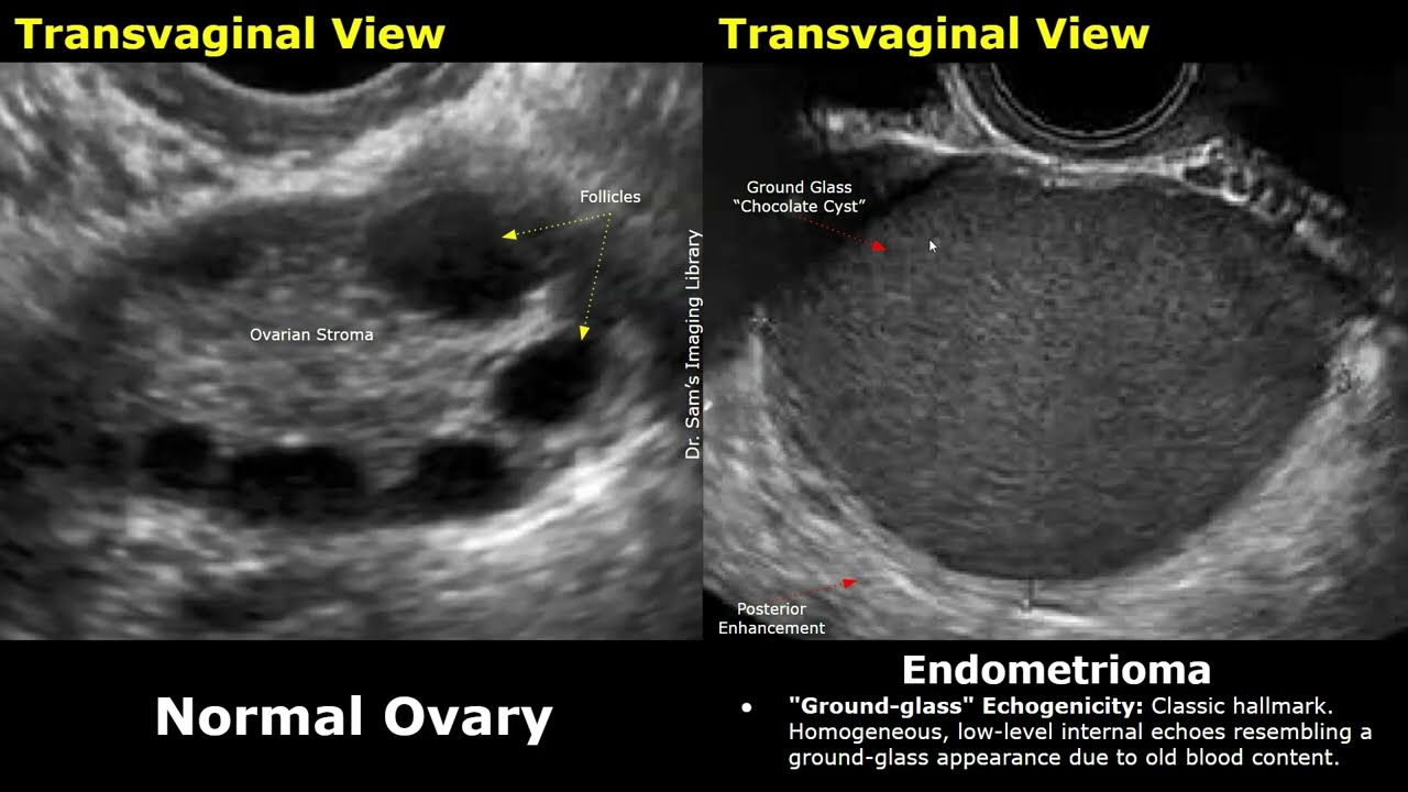 Ovary Ultrasound Normal Vs Endometrioma Imaging Findings | Chocolate Cyst. Ground Glass Appearance