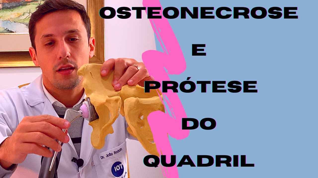 Protese de Quadril em Osteonecrose