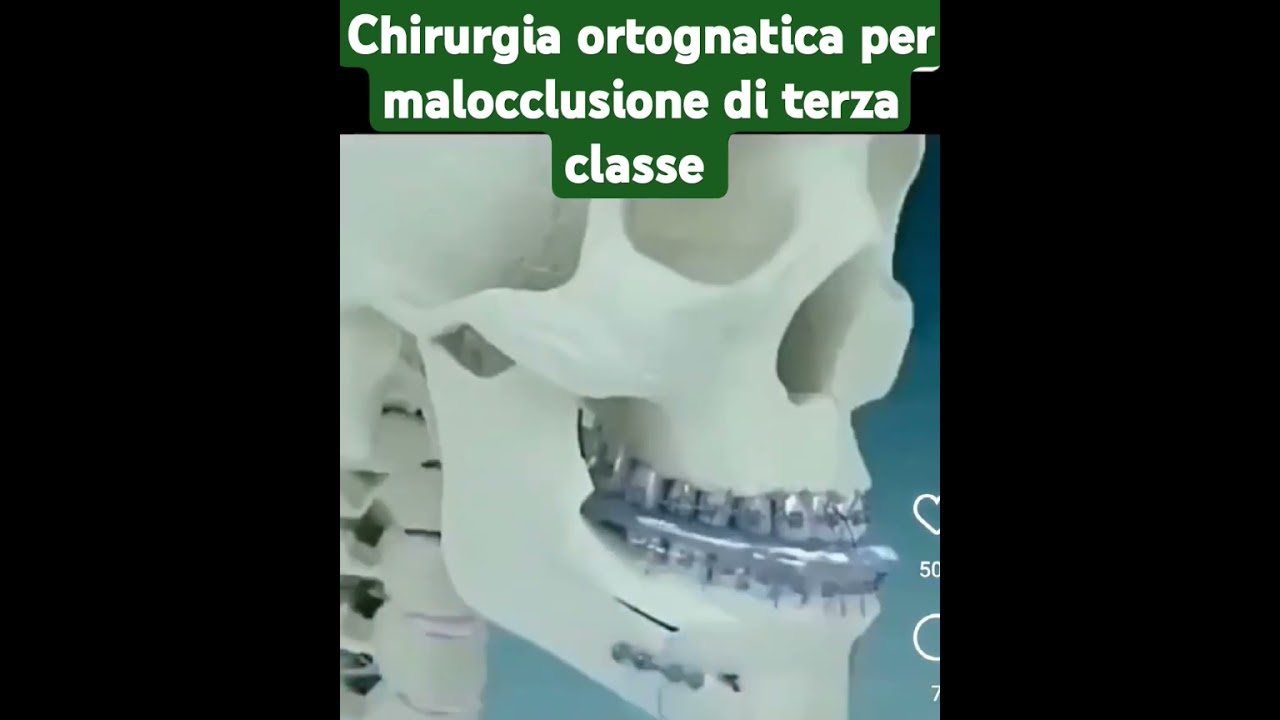 chirurgia ortognatica per malocclusione di terza classe
