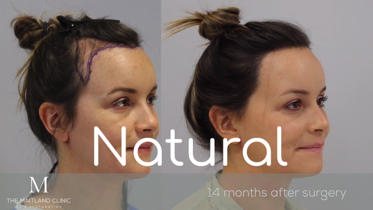 Female Hair Transplant FUT, Hairline Lowering-2150 Grafts-Maitland Clinic-Dr. Ball