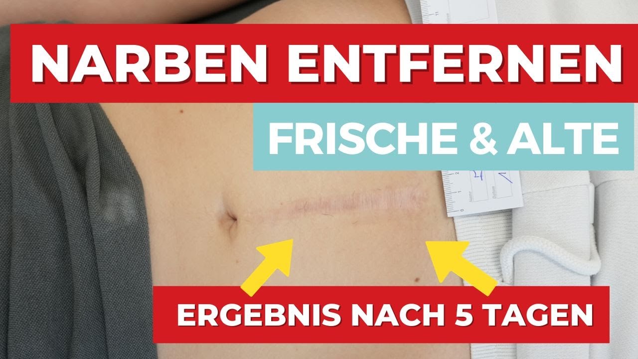 Narben entfernen - frische & Alte Narben - Das Ergebnis nach 5 Tagen