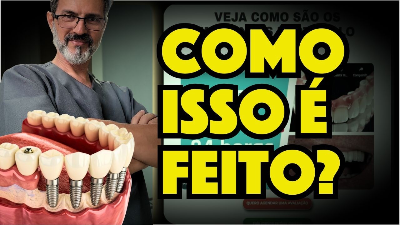 COMO SÃO COLOCADOS OS IMPLANTES PROTOCOLO?